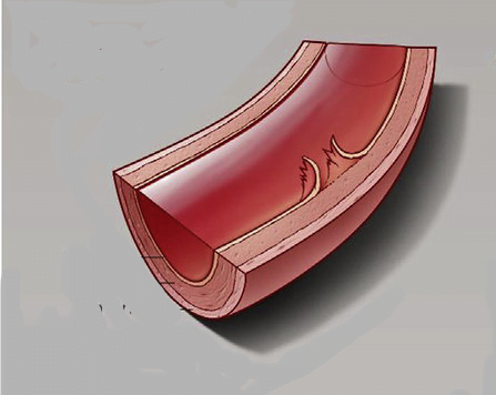 Why The Intrinsic Pathway Needed When The Extrinsic Pathway of Blood Clotting Exists